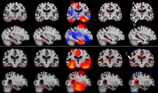 Generative Modelling on Big Medical Datasets